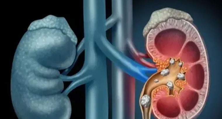 కిడ్నీలో రాళ్లను కరిగించే పానియాలివే!