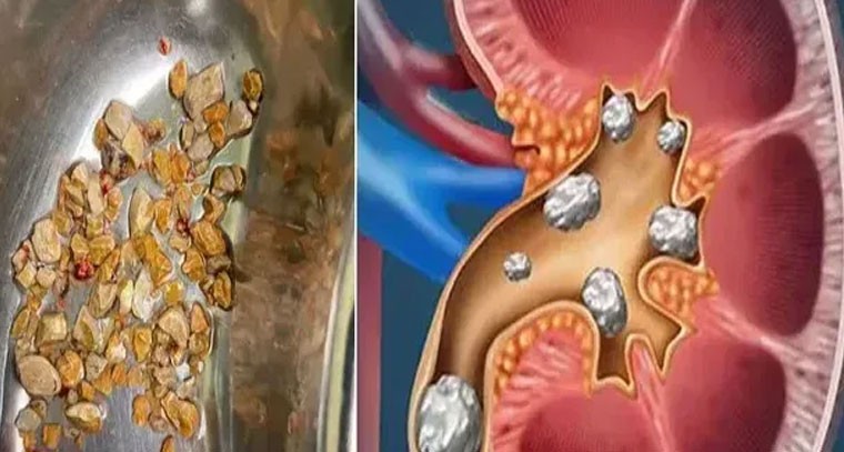 కిడ్నీ లో రాళ్లు: ఈ 3 లక్షణాలను గమనించండి!