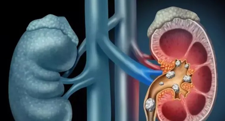 కిడ్నీలో రాళ్లకు చెక్ పెట్టండిలా..