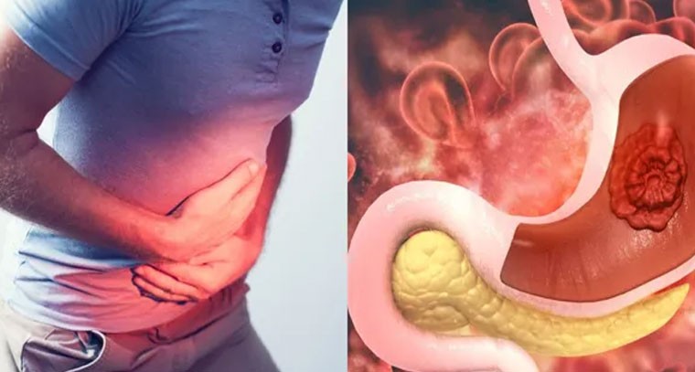 అల్సర్‌కు దారితీసే సాధారణ అలవాట్లు.. జాగ్రత్త పడండి!