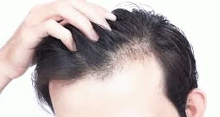 తగినంత నిద్ర లేకపోతే జుట్టు పైనే తీవ్ర ప్రభావం