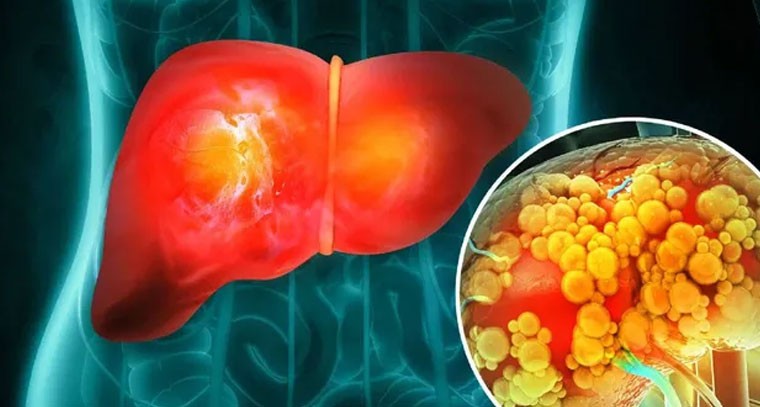 మలం రంగు మారితే నిర్లక్ష్యం వద్దు!`