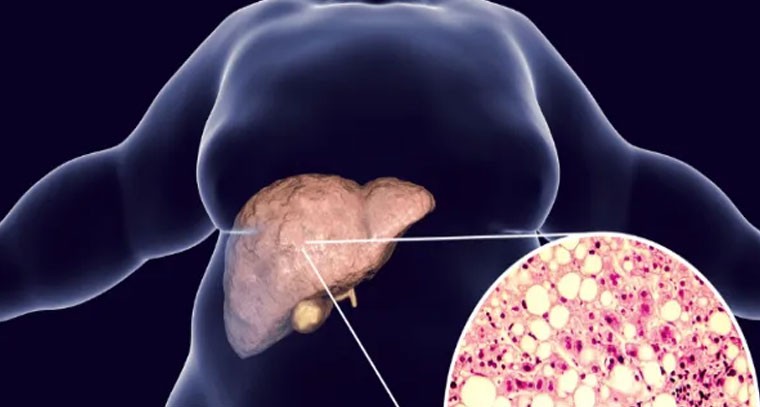 మద్యం తాగకపోయినా ఫ్యాటీ లివర్