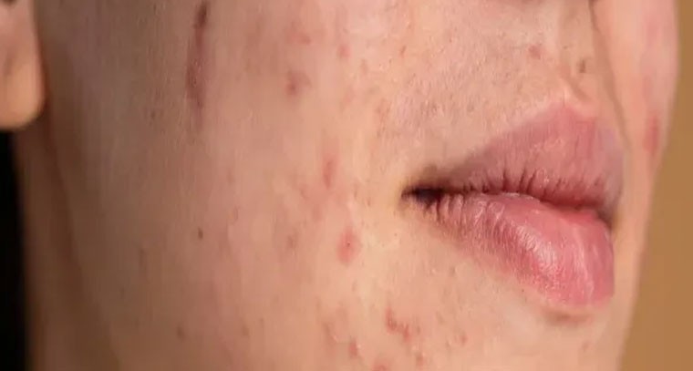 మొటిమలు, మచ్చలకు సహజ చిట్కాలు