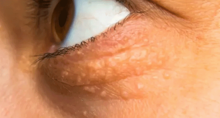 ముఖంపై ఈ లక్షణాలు కనిపిస్తే కొలెస్ట్రాల్ పెరిగినట్లే!