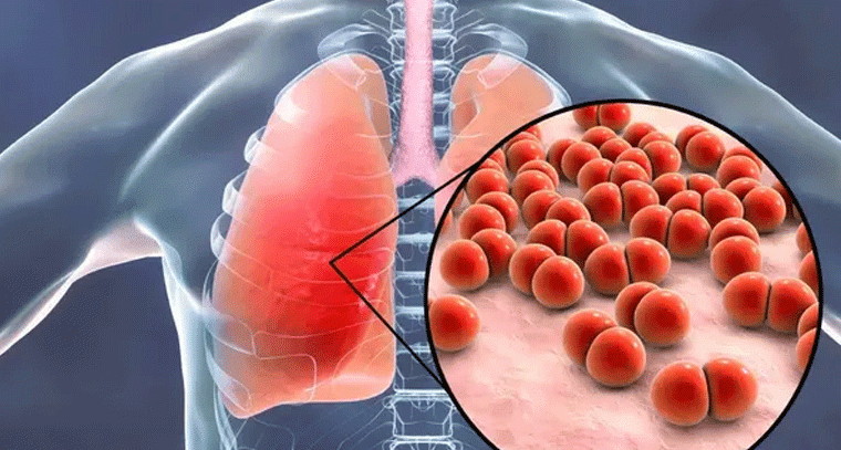 న్యూమోనియాను నిర్లక్ష్యం చేస్తే ప్రాణాలకే ముప్పు: డా. గంగాధర్ రెడ్డి