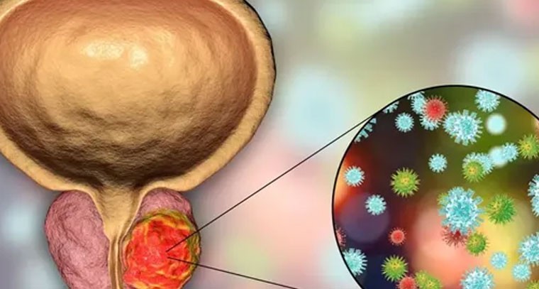 ప్రాణాంతకమైన క్యాన్సర్.. ప్రోస్టేట్ క్యాన్సర్