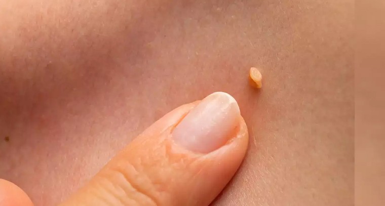 ఇలా చేస్తే పులిపిర్లు దెబ్బకు మాయమవుతాయి..!