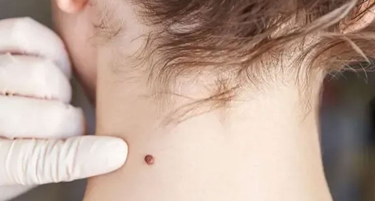 పులిపిర్లు ఎందుకు వస్తాయో తెలుసా?