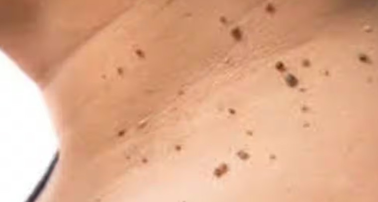 పులిపిర్లు రాకుండా ఉండాలంటే ... ఇలా చేయండి 