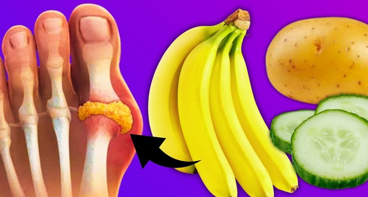 యూరిక్ యాసిడ్‌ తగ్గాలంటే అరటిపండు తినాల్సిందే 