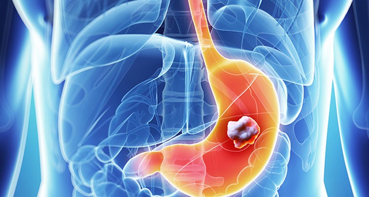 పురుషులలో ఎక్కువగా కనిపించే కడుపు క్యాన్సర్ యొక్క 5 లక్షణాలు !