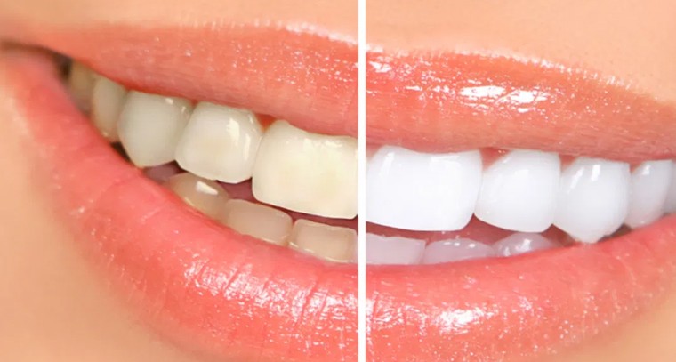 కొన్ని రోజుల్లో పసుపు దంతాలను తెల్లగా మార్చే అద్భుత చిట్కా 