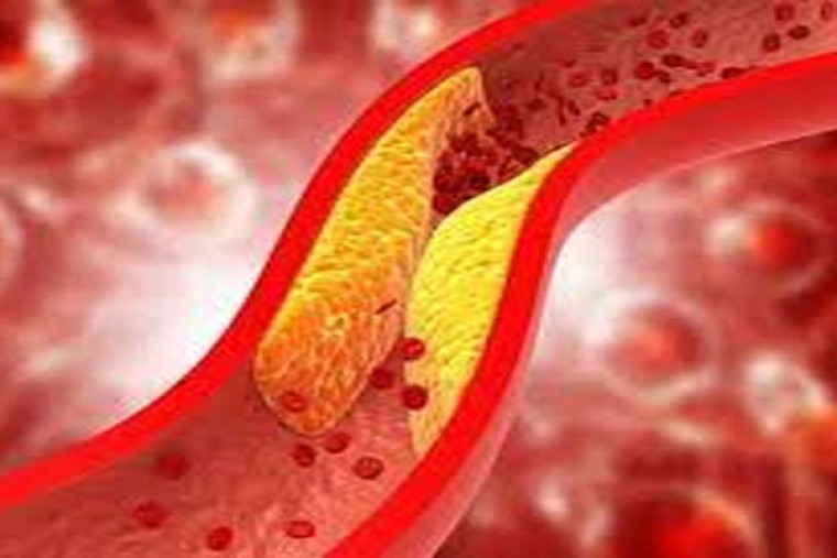 చెడు కొలెస్ట్రాల్‌ని ఇలా చెక్ పెట్టండి 

