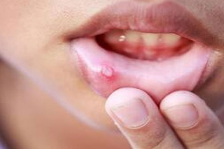 నోటిపూత సమస్యకు చెక్ పెట్టండి

