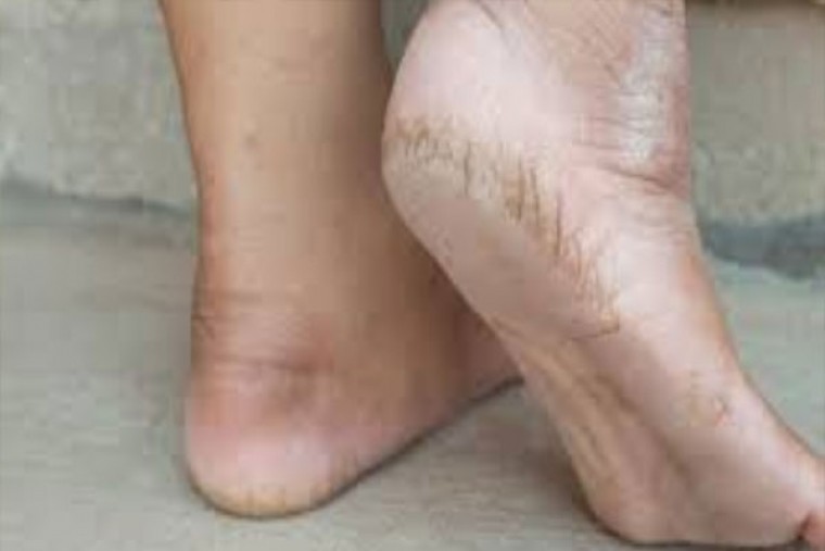 పాదాలు పగుళ్లు సమస్యకు చెక్ పేటండి 

