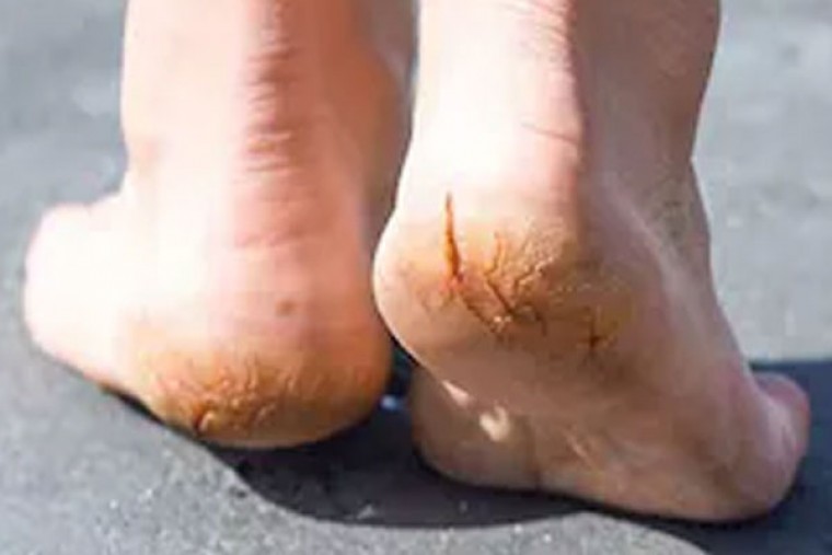 పాదాలు పగుళ్లుతో బాధపడుతున్నారా 

