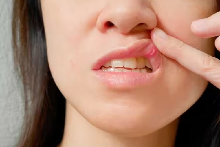 నోటి పూత సమస్యకు ఇలా చెక్ పెట్టండి

