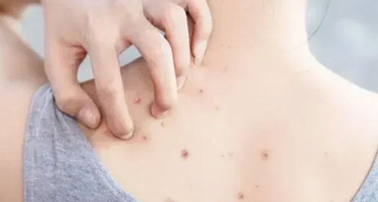 వీపుపై మొటిమలు: దుస్తులు, ఆహారం, ఒత్తిడితో జాగ్రత్త!
