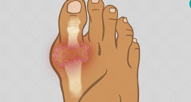 యూరిక్ యాసిడ్ తగ్గాలంటే ఏం చేయాలో తెలుసా ?