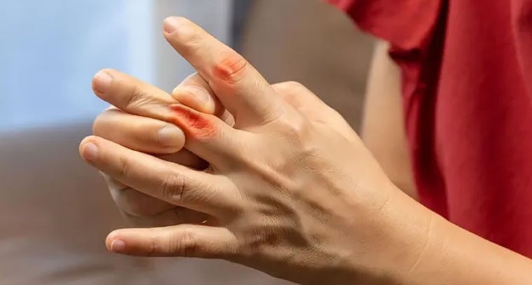 యూరిక్ యాసిడ్ పెరిగితే ఏం జరుగుతుందో తెలుసా?