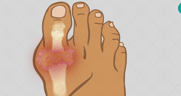 యూరిక్ యాసిడ్‌ను ఎలా నియంత్రించాలి