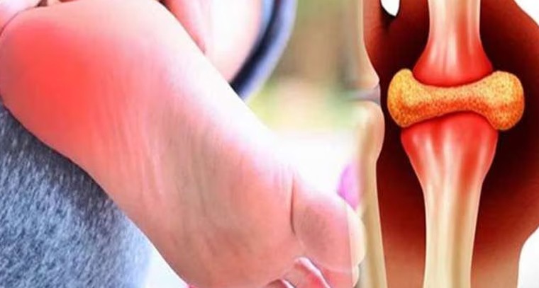 యూరిక్‌యాసిడ్‌ పెరిగినట్లే.. ఇలా వదిలించుకోండి..