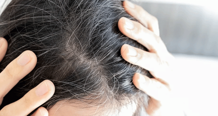 తెల్ల జుట్టుకు శాశ్వత పరిష్కారం..