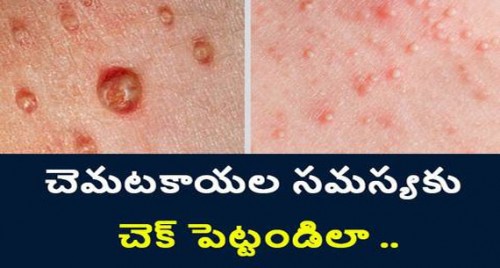 చెమటకాయల సమస్య వేధిస్తోందా? అయితే ఇలా చేయండి..!

