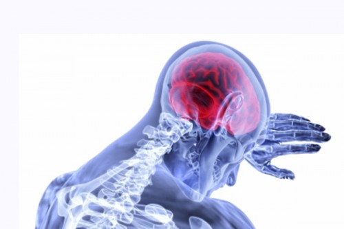 UK researchers develop new tool to reduce stroke risk