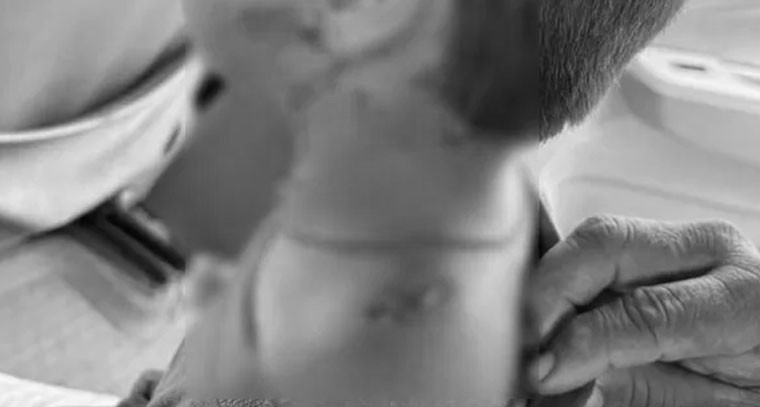 తోషం తండాలో వీధికుక్క దాడి.. బాలికకు తీవ్ర గాయాలు