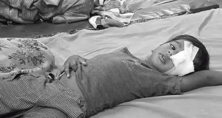 వీధి కుక్కల దాడిలో కన్నుకొల్పోయిన చిన్నారి