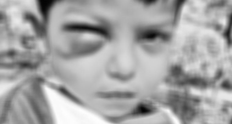 అల్లరి చేస్తున్నాడని బాలుడి కన్ను పోయేలా కొట్టిన అంగన్వాడీ టీచర్ 