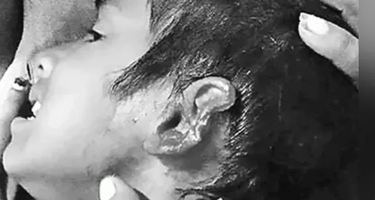 కుక్క కాటుకు తెగిపడ్డ చిన్నారి చెవి