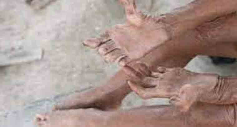 కుష్టు వ్యాధిని అరికట్టిన భారత ప్రభుత్వం 
