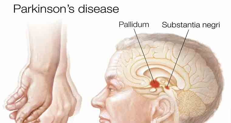 పార్కిన్సన్స్ వ్యాధిపై కీలక విషయాలు కనుగొన్న ఆస్ట్రేలియా పరిశోధకులు