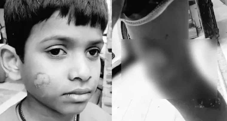 దారుణం.. ఏడేళ్ల బాలుడిని అట్లకాడతో కాల్చిన ట్యూషన్ టీచర్