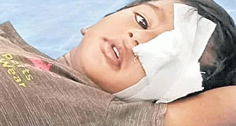 వీధి కుక్కల దాడిలో చూపు కోల్పోయిన మూడేళ్ల చిన్నారి